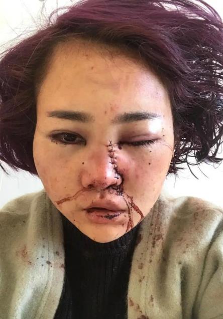 女子在丽江游玩时遭十余人暴打 被划脸毁容